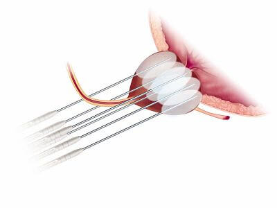 Cryoablation probes inserted transperineally into the prostate forming ice balls, the freeze-and-thaw mechanism Dr. Wei Phin Tan uses to destroy prostate cancer cells while sparing surrounding tissue