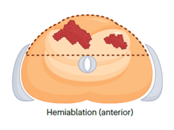 Anterior hemiablation cryoablation pattern, entire anterior half of the prostate treated, axial view