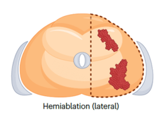Lateral hemiablation cryoablation pattern, entire left or right half of the prostate treated, axial view