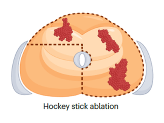 Hockey-stick cryoablation pattern, L-shaped treatment combining anterior and lateral coverage, axial view of prostate