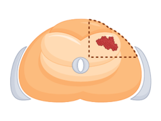 Quadrant cryoablation, single anterolateral quadrant treated, dashed ablation boundary, axial view of prostate