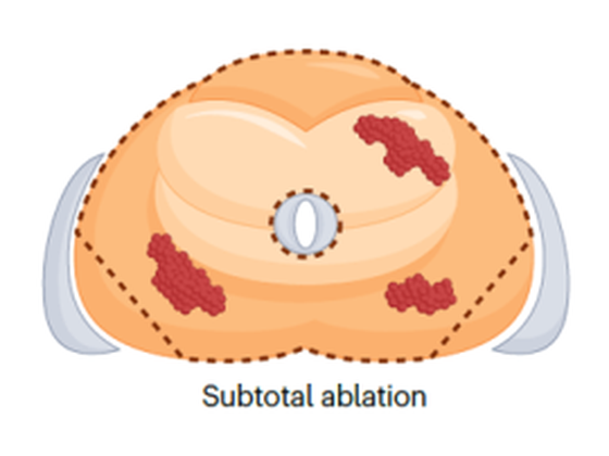 Subtotal cryoablation pattern, most of the gland ablated while sparing neurovascular bundle, axial view of prostate